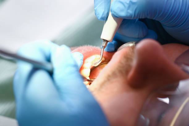 Best Emergency Dental Care for Broken or Chipped Teeth in San Andreas, CA